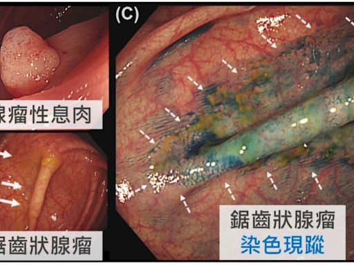 大昌醫院團隊研究年輕型大腸息肉 獲頂尖國際期刊刊登