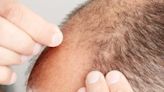 Hair loss drug in Propecia, Proscar may lower risk of heart disease