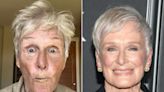 Glenn Close Shows 'Beautiful' Bruised Face on Eve of 77th Birthday After Suffering a ‘Tiny Break in My Nose’