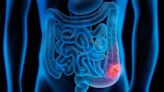 Phase 2 Study Shows Opdivo-Yervoy Highly Effective In Colon Cancer