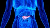 Pancreatic cancer rates are rising fastest in young women and experts aren’t sure why