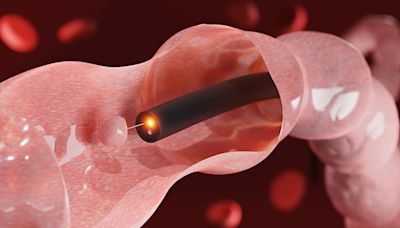 Negative Colonoscopy? 15-Year Screening Interval May Be Safe