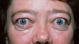 Triamcinolone Offers Relief in Thyroid Eye Disease