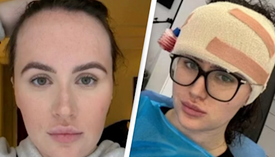 Woman showcases the results of 'life-changing' $11,000 surgery to make her forehead smaller