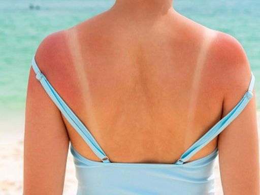 8 ways to help soothe your painful heatwave sunburn