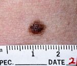 Nevus