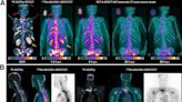 New SPECT/CT technique shows impressive biomarker identification, offers increased access for prostate cancer patients