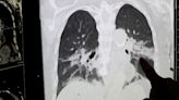 Most of India's lung cancer cases are linked to non-smokers. Here's why