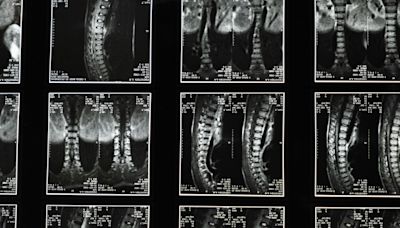 Arm fat may reveal women and men at risk of spinal fracture