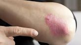 Researchers identify gene mutation that causes psoriasis