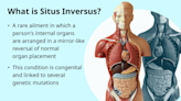 Situs Inversus: The Effects of Reversed Anatomy