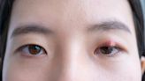 小心3個壞習慣害你長針眼！ 眼科醫警告：拉眼尾、戳破膿包恐愈慘