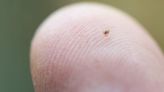 Preventing Lyme Disease - What you need to know