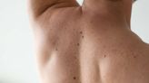 Types of Moles (and When to Consider Getting One Checked)