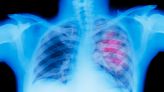 Lung cancer mystery: Why are healthy, non-smoking, Asian women contracting the disease?