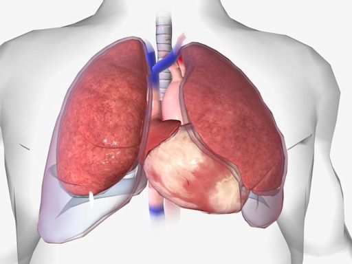 Pleural Dynamics treats first patient with pleural effusion device
