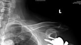 阿北肱骨粉碎性骨折 反置式關節加快癒合 - 自由健康網