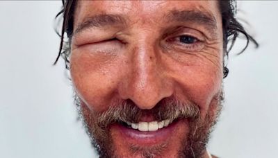 Matthew McConaughey’s face horrifically swollen by bee sting