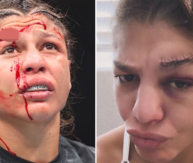 UFC star reveals gruesome scar after suffering gaping gash 'down to the bone'