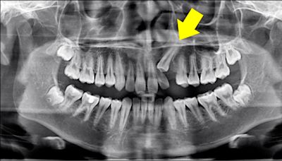 改斜歸正！牙齒阻生 早期矯正斷禍根 - 自由健康網