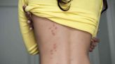 Signs and Symptoms of Bed Bug Bites