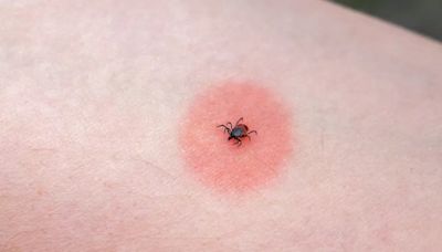 NHS shares symptoms and first aid for 14 different types of insect bites