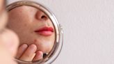 8 common questions about acne, answered by dermatologists
