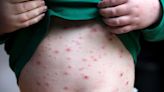 Chickenpox vaccine should be given to toddlers on the NHS, say health chiefs