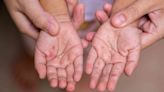 Signs and Symptoms of Hand, Foot, And Mouth Disease (HFMD)