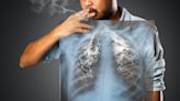 Cáncer de pulmón: buenas noticias desde la batalla para derrocar al emperador de los tumores