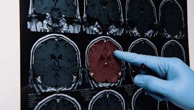 Hallan una nueva forma de pérdida de memoria que se confunde con el Alzheimer