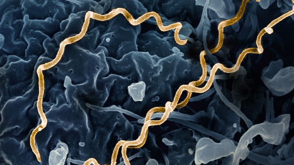 Doctors seeing more syphilis patients with unusual and severe symptoms, study shows