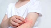 濕疹是一種慢性皮膚病症，當症狀發作時，令人心癢難耐，且難以治愈。一名患有十幾年濕疹及過敏性鼻炎的患者，改吃純肉飲食後，症狀全部消失，其背後的機制有很大的可信性。