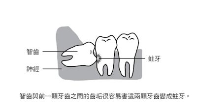智齒長出來一點有需要拔嗎？牙醫揭「先照X光再說」：1情況不能留