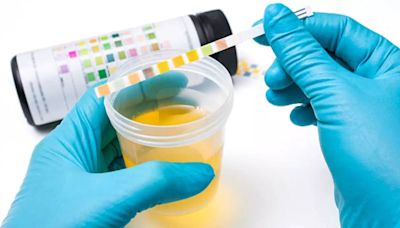 What Does Your Urine Colour Say About Your Kidney Health? Know Here