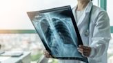 Endeavor’s ENV-101 improves lung function in Phase IIa IPF trial