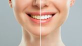 露齒笑怕被發現牙黃？推薦5款牙齒美白產品幫你你輕鬆擁有耀眼笑容，自信笑不再煩惱