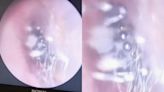 Video: Doctor in China discovers live spider nesting inside woman's ear