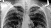 Radiografía del cáncer de pulmón en España: más mujeres, pacientes cada vez más jóvenes y, detrás, el tabaco
