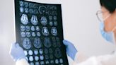 Poor metabolic health linked to worse brain health