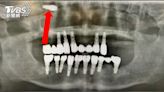 「植牙體」掉入上頷竇 中年男植牙變鼻竇炎
