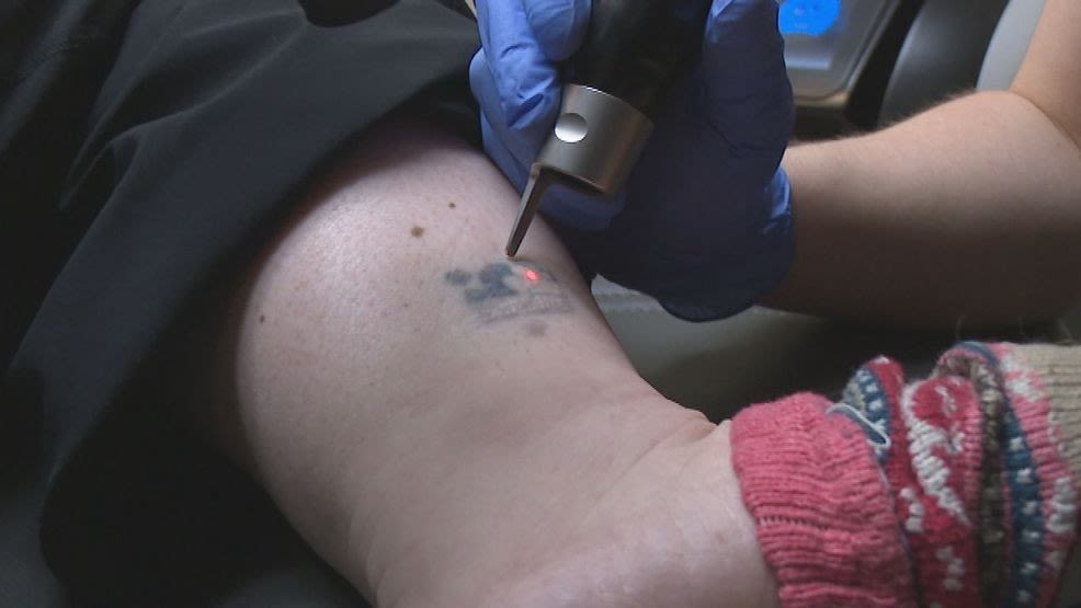 Rising trend in tattoo removal has experts clarifying misconceptions