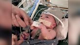 1st partial-heart transplant growing with baby 1 year later