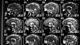 Alzheimer em 10 anos: o que há de mais avançado para controlar a progressão da doença (e os efeitos colaterais das novas drogas)