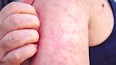 Measles: Why the disease is on the rise and how to spot the signs