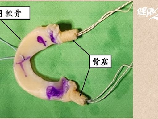 膝蓋痛怎麼辦？膝蓋卡卡能治療嗎？半月板受損用異體移植 避免提早換關節