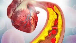 How high cholesterol, microplastics are contributing to rising heart diseases - News Today | First with the news