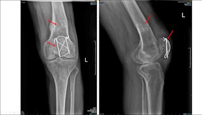 髖關節病變「企鵝撞」 3D人工膝關節置換助改善 - 自由健康網