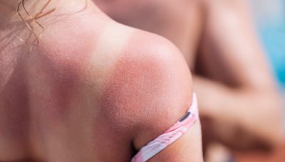 What causes skin cancer? What to know about basal cell carcinoma and symptoms