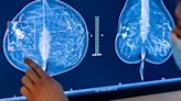 In Reversal, Expert Panel Recommends Breast Cancer Screening at 40